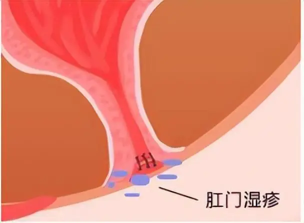 肛门大便失禁吃什么药_肛门失禁的症状不排便_肛门症状排便失禁怎么办