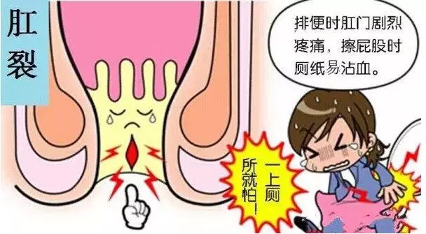 肛门失禁的症状不排便_肛门症状排便失禁怎么办_肛门大便失禁吃什么药
