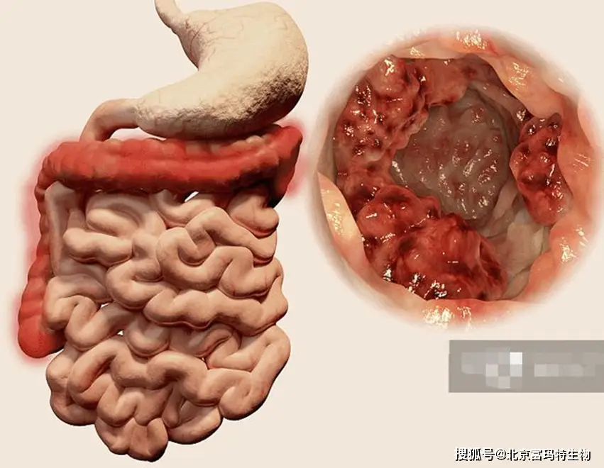 小肠克罗恩病吃什么药_小肠克罗恩病能治好吗_小肠克罗恩病要终身服药吗