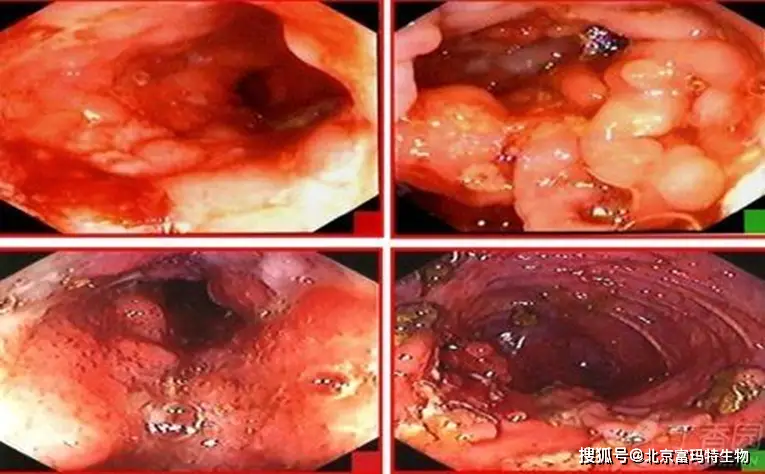 crohn病是什么医学意思_crohn病是什么疾病_crohn