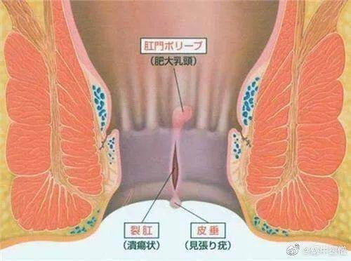 肛门失禁患者_肛门失禁最常见的并发症_如何让肛门失禁