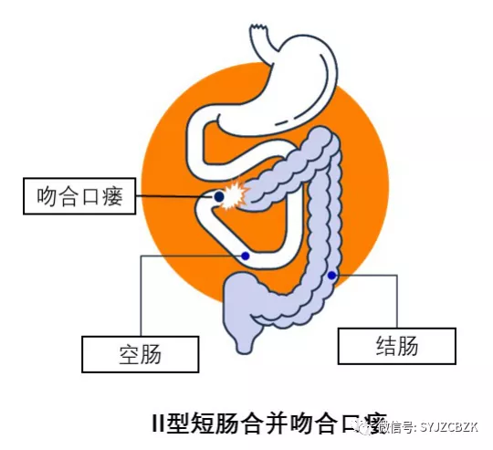 大便常规能查出克罗恩病吗_大便病是什么病_克罗恩病的大便图片