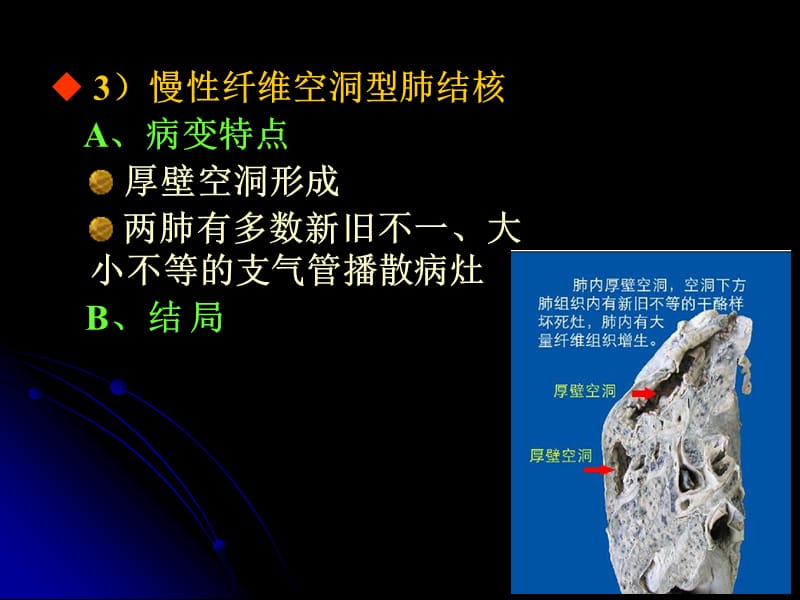 继发性肺结核要注意哪些饮食_肺结核性继发注意什么_继发性肺结核注意什么