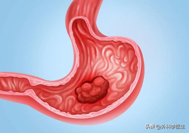 康复主任医师简介_康复主任胃病中心李主任医师_康复中心李主任胃病