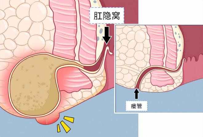 克罗恩病肛瘘与普通肛瘘的区别_克罗恩肛瘘和普通肛瘘_肛瘘一定是克罗恩吗