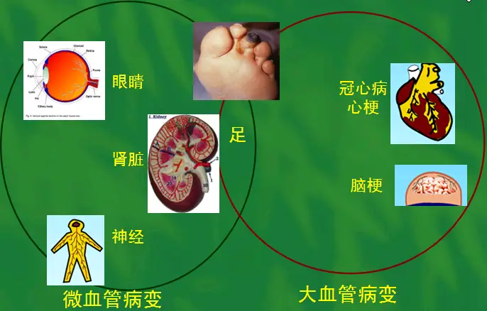 心梗介入治疗并发症_心肌梗死介入后的并发症_心肌梗塞介入手术并发症