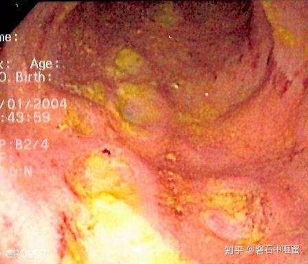 克罗恩病诊断临床分型_罗克恩病怎么确诊_罗克罗恩病的特征性体征