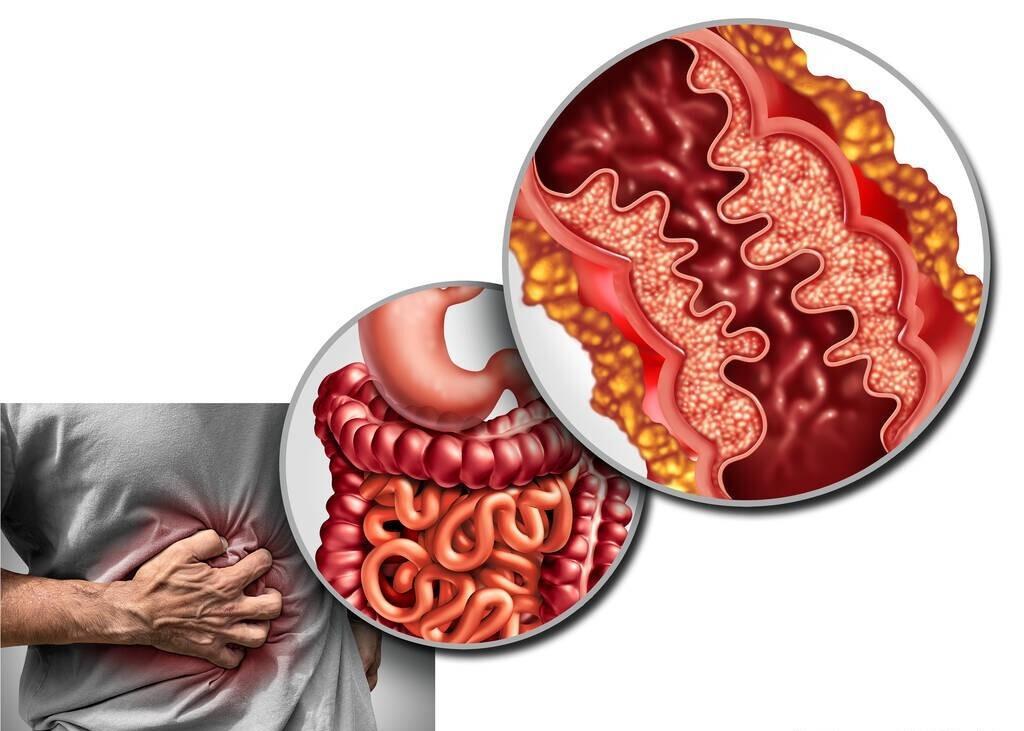 crohn_crohn病是什么医学意思_crohn病是什么疾病