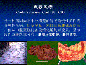 护理措施字母表示_克罗恩病的护理查房_克罗恩病护理措施