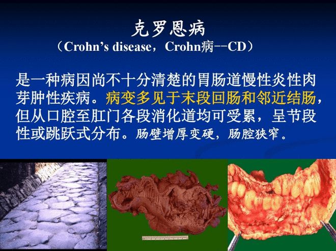 克罗恩病典型x线征象_克罗恩病 x线_罗克罗恩病