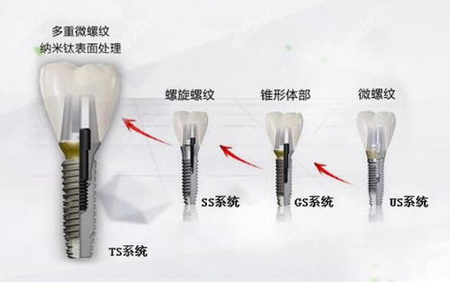 osstem种植牙系统,引领口腔种植技术新潮流